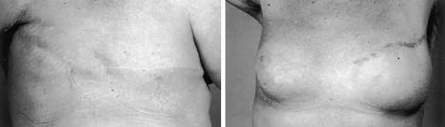 بازسازی-پستان