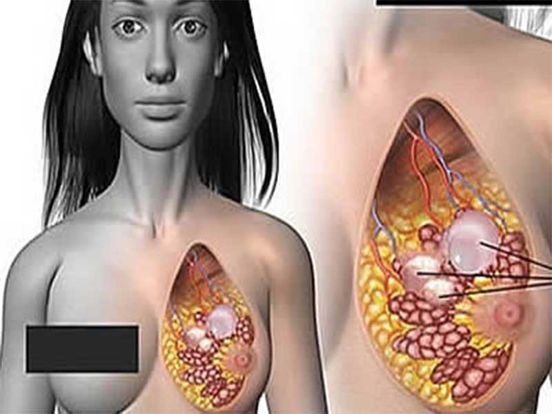 تخلیه کیست های پستان