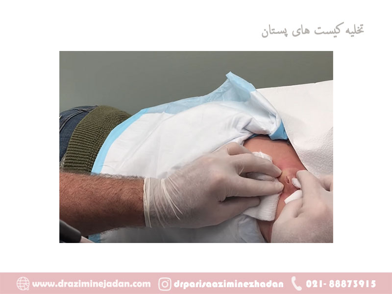 تخلیه-کیستهای-پستان