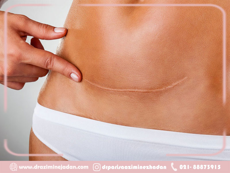 ابدومینوچلاستی