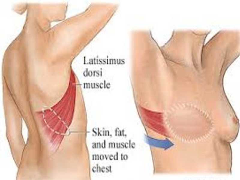 جراحی-بازسازی-پستان