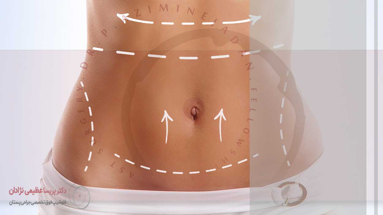جراحی زیبایی شکم