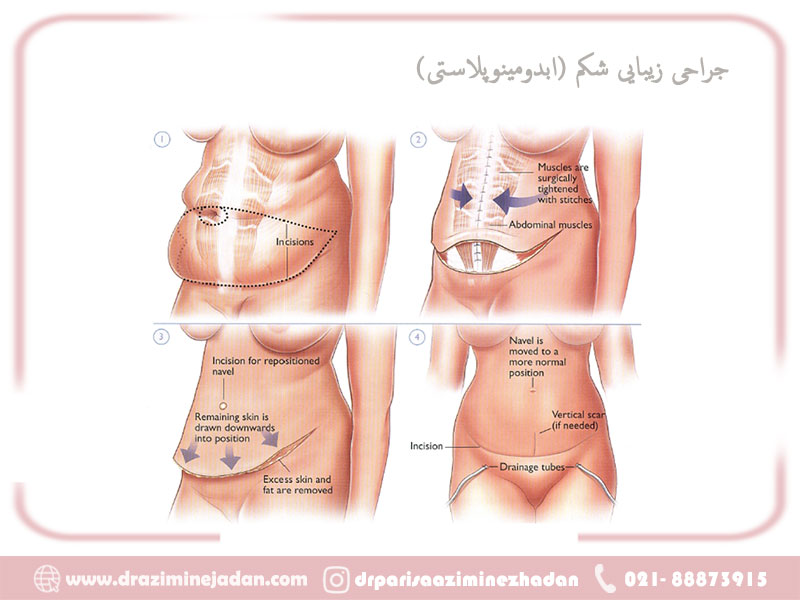 ابدومینوپلاستی