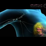 خارج کردن توده پستان
