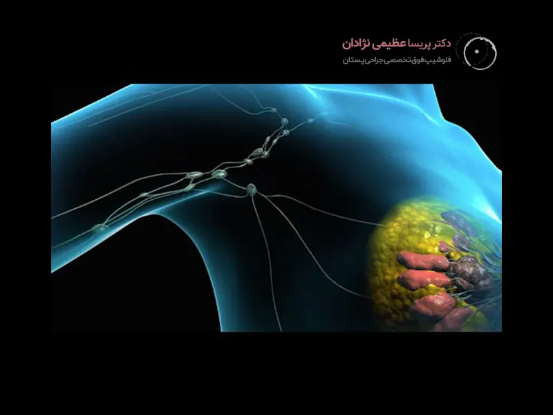 خارج کردن توده پستان