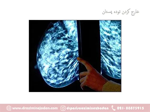 درآوردن توده پستان