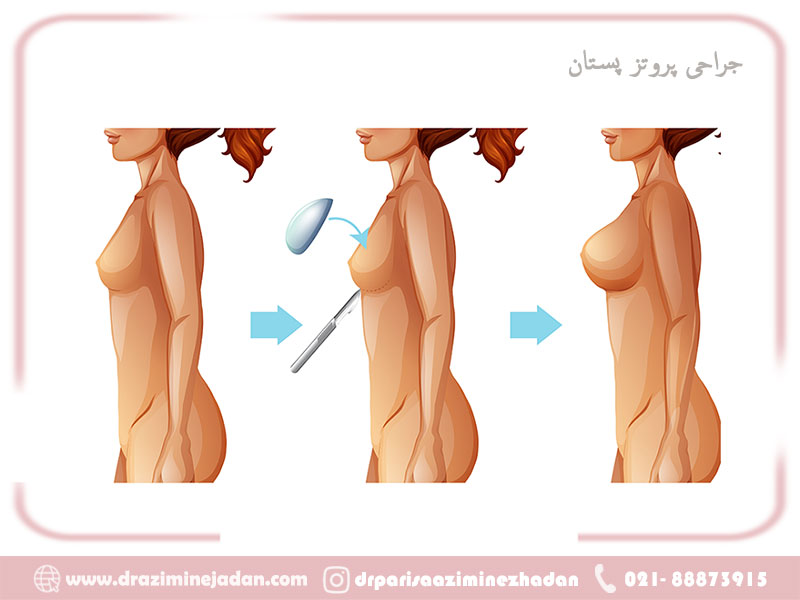 پروتز پستان