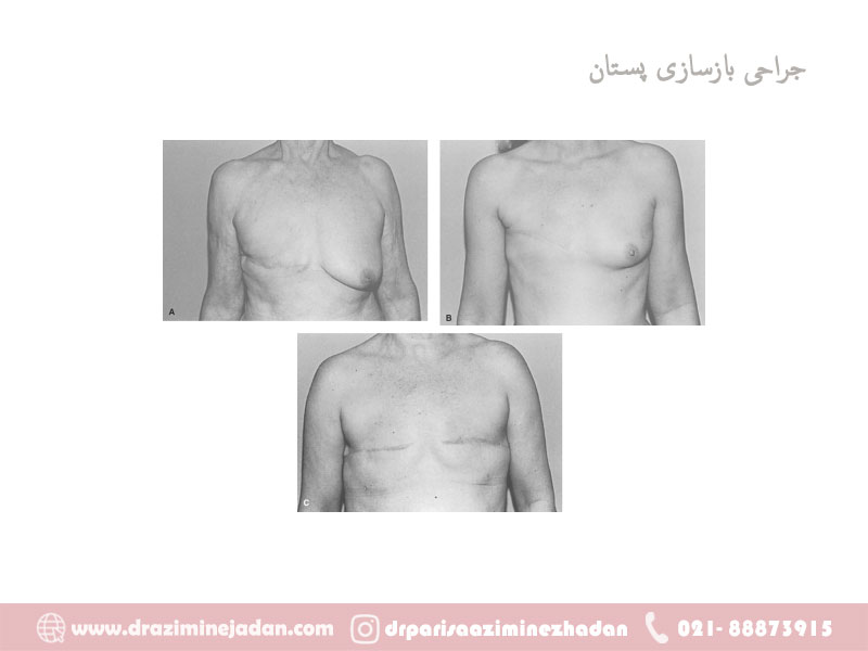 عمل-بازسازی-سینه