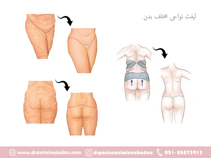 لیفت-نواحی-مختلف-بدن