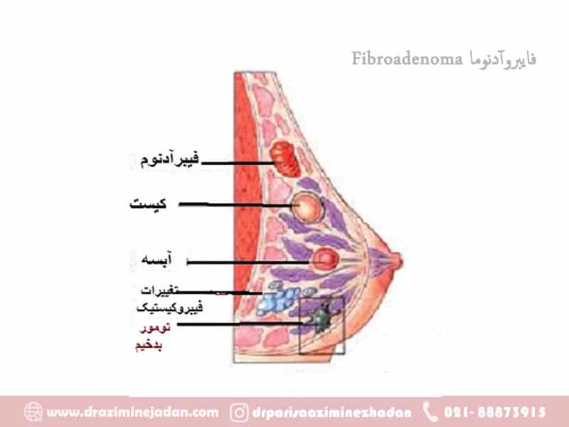 فایبروآدنوما-Fibroadenoma