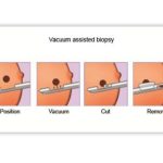 VACUUM ASSISTED BIOPSY