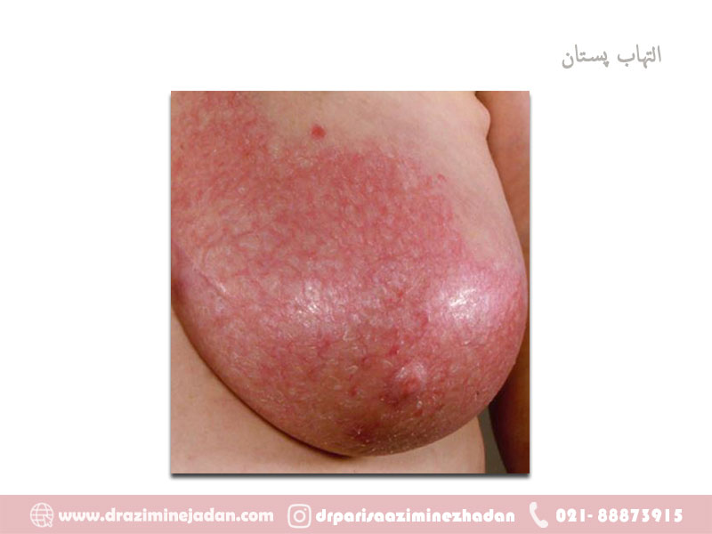 التهاب پستان