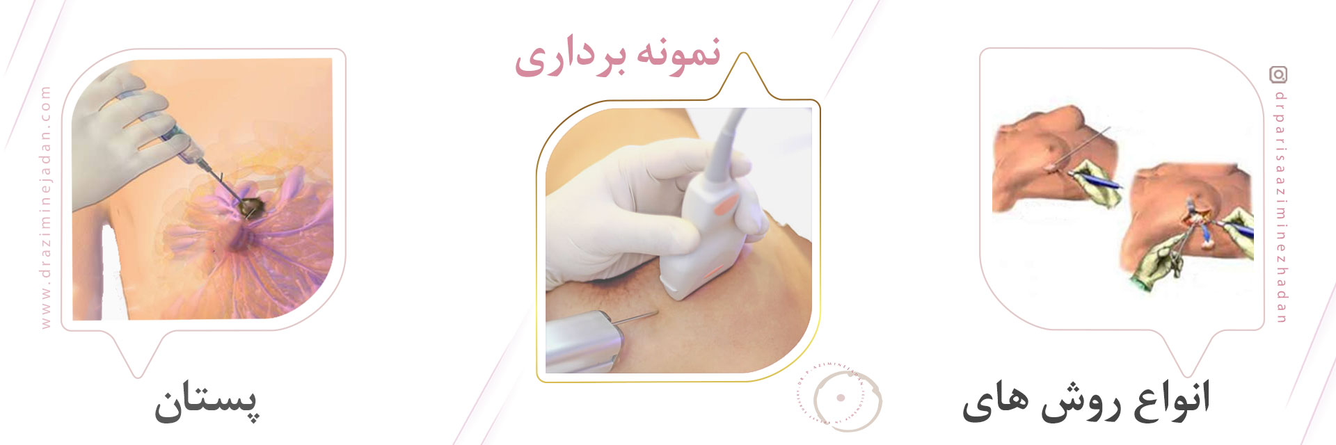 انواع روش های نمونه برداری پستان