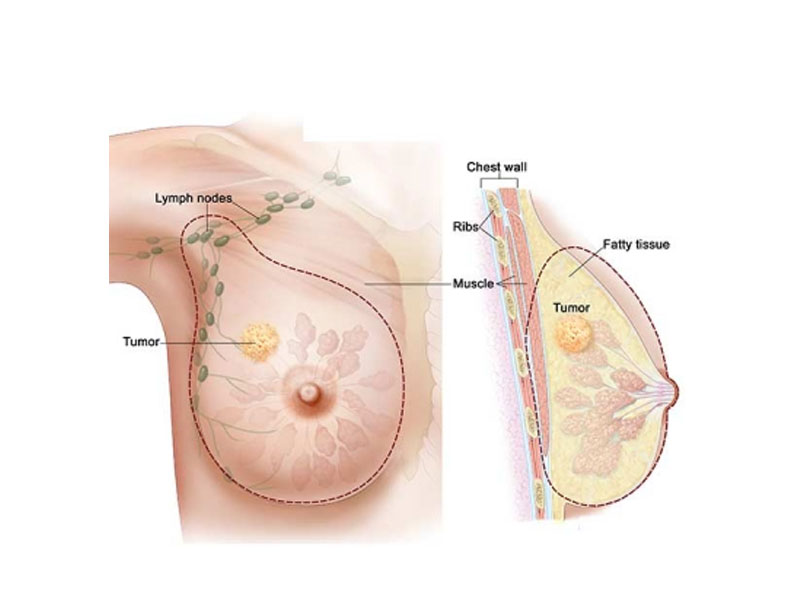 بیماری های خوش خیم و بدخیم پستان