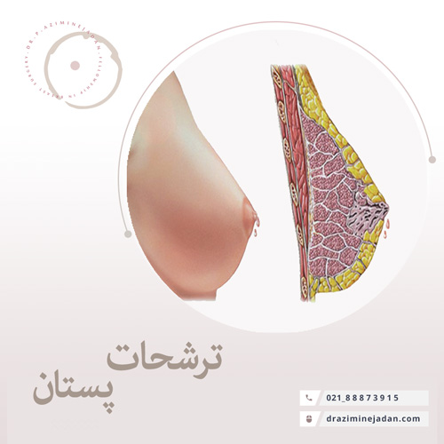 ترشحات پستان