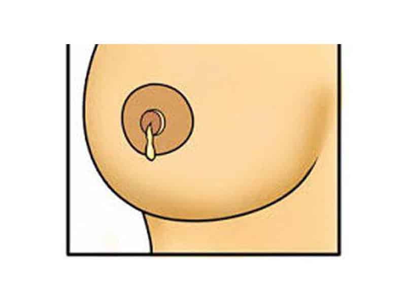 ترشحات پستان