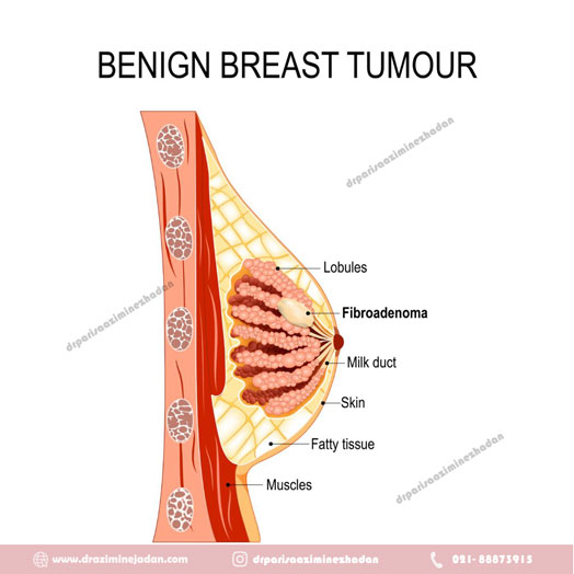 توده-های-خوش-خیم-پستان