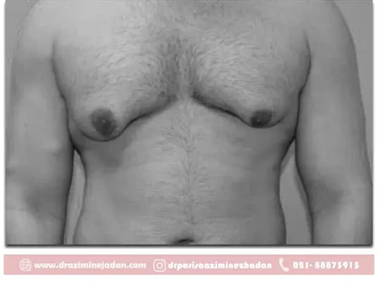 جراحی ژنیکوماستی