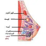فایبروآدنوما Fibroadenoma