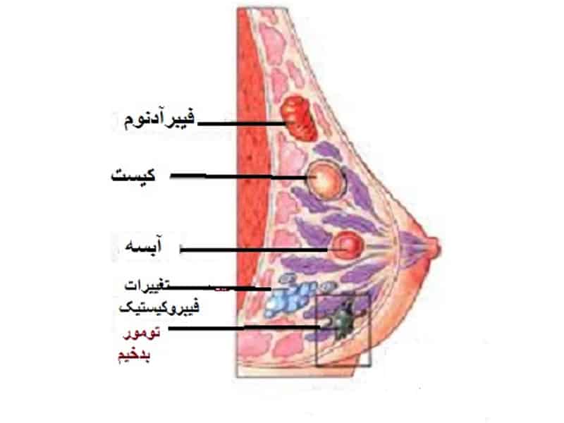 فایبروآدنوما Fibroadenoma