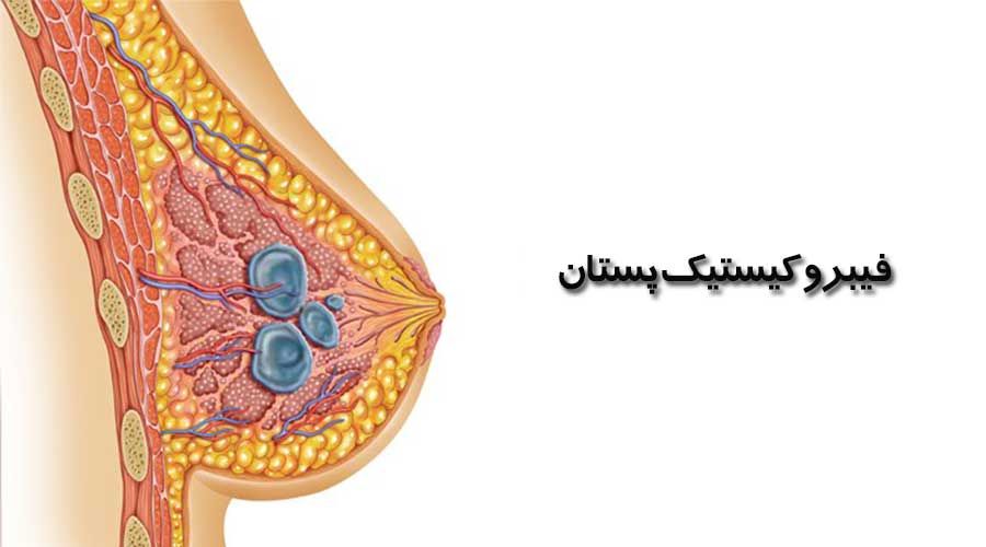 فیبروکیستیک