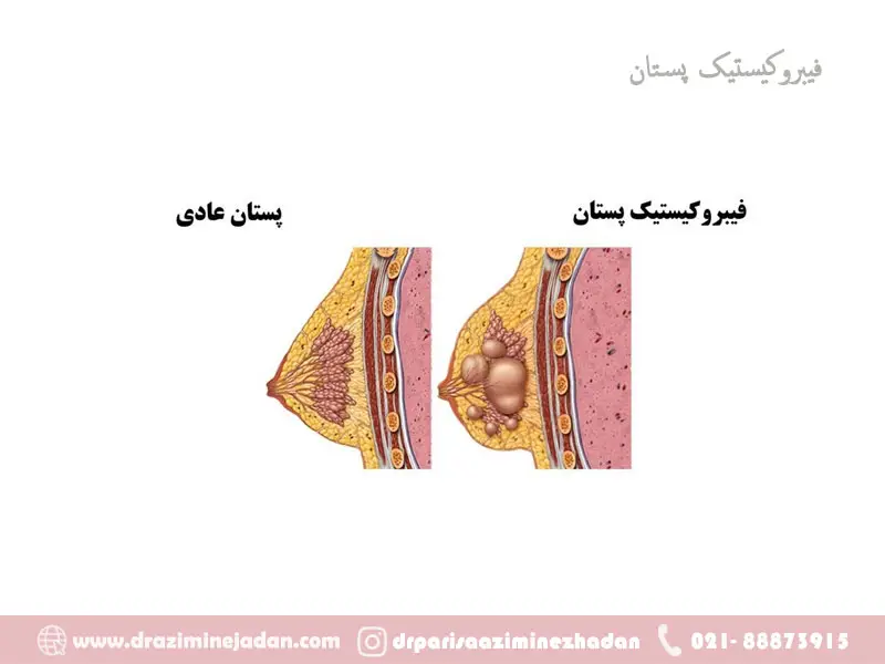 فیبروکیستیک پستان