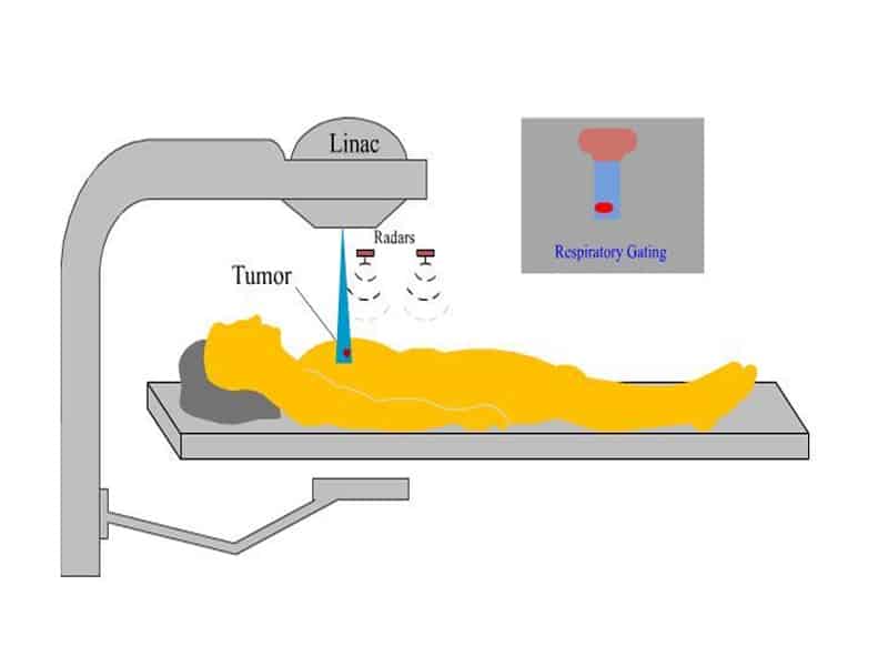 معجزه-رادیوتراپی-و-شیمی‌درمانی-در-سرطان