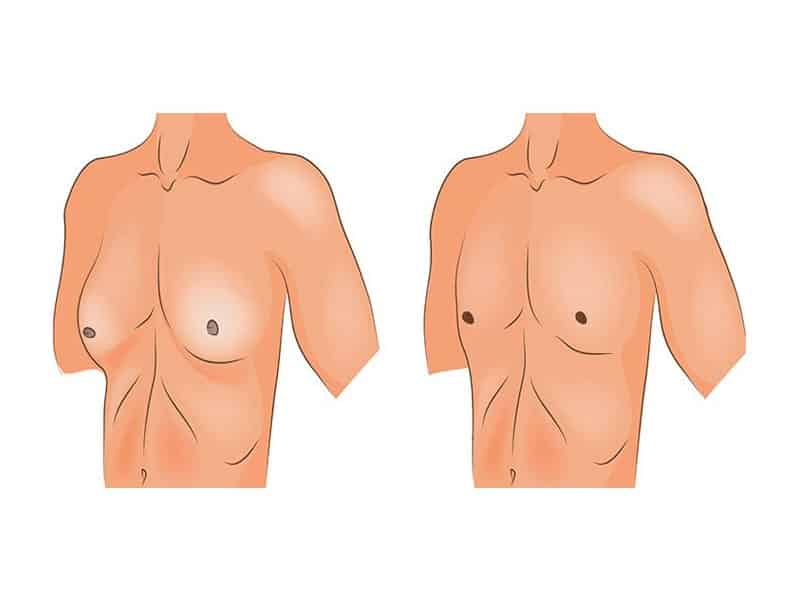 ژنیکوماستی