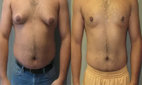 عمل ژنیکوماستی