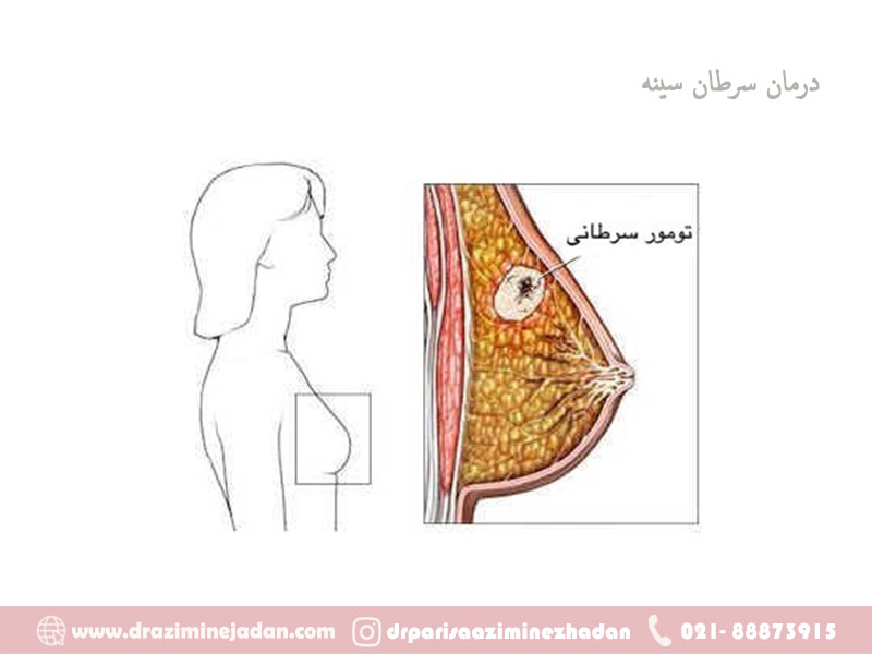 درمان-سرطان-سینه