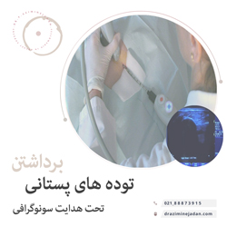 برداشتن توده های پستانی تحت هدایت سونوگرافی