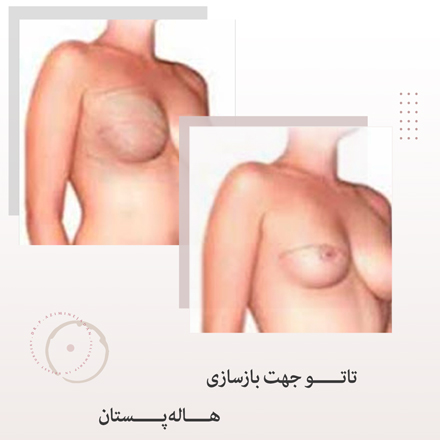 تاتو-جهت-بازسازی-هاله-سینه