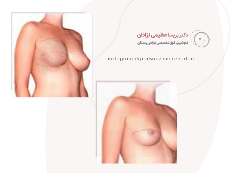 تاتو-هاله-سینه