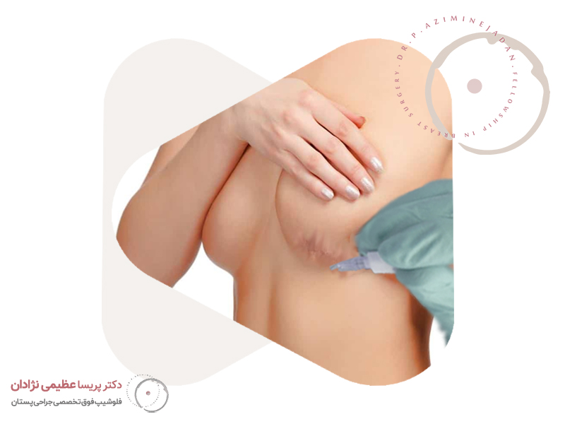 کربوکسی تراپی پستان