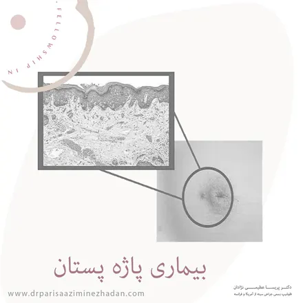 بیماری-پاژه-پستان