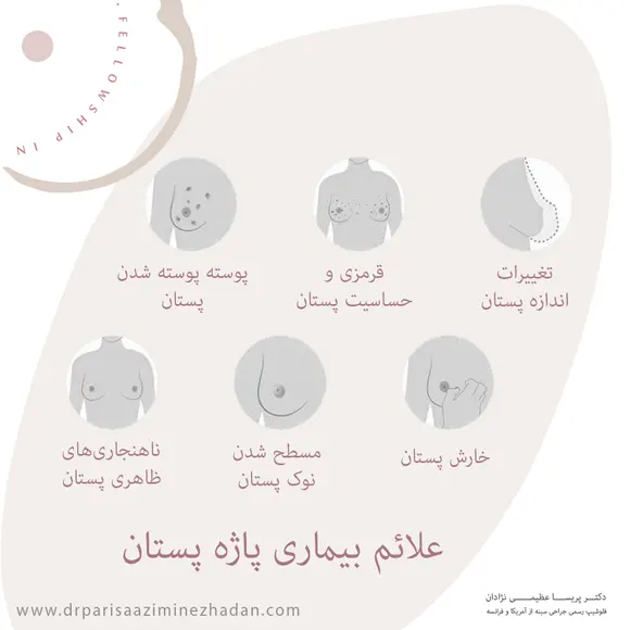 علائم-بیماری-پاژه-پستان