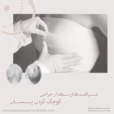 مراقبت-های-بعد-از-جراحی-کوچک-کردن-پستان