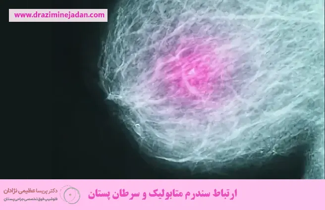 ارتباط سندرم متابولیک و سرطان پستان ارتباط سندرم متابولیک و سرطان پستان