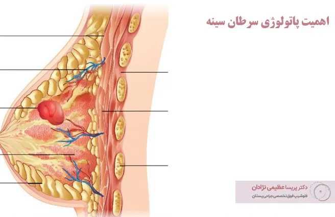 اهمیت پاتولوژی سرطان سینه اهمیت پاتولوژی سرطان سینه