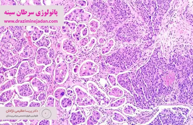 پاتولوژی سرطان سینه پاتولوژی سرطان سینه