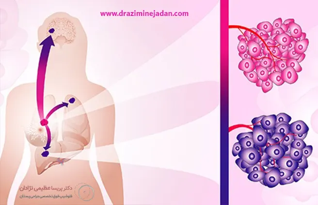 تشخیص سرطان متاستاتیک سینه تشخیص سرطان متاستاتیک سینه