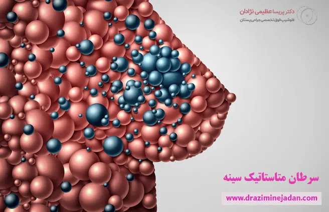 سرطان متاستاتیک سینه سرطان متاستاتیک سینه