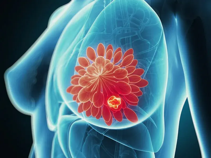 علائم سرطان متاستاتیک پستان