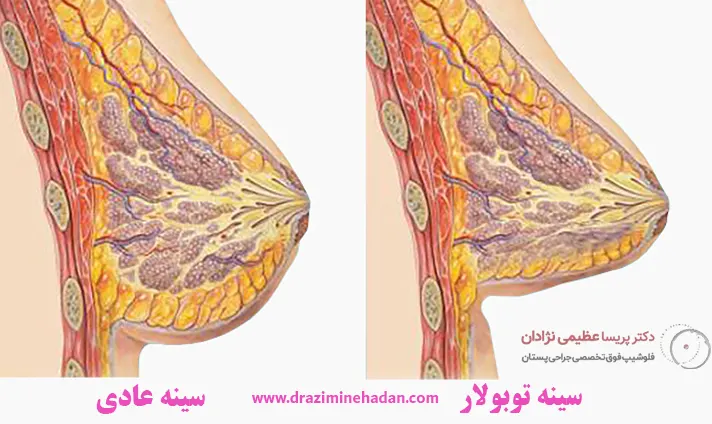 سینه توبولار سینه توبولار