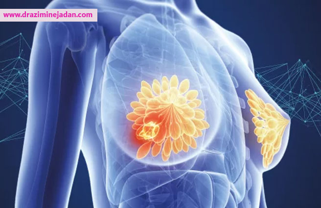 علائم-سرطان-سینه-استیج-صفر علائم-سرطان-سینه-استیج-صفر