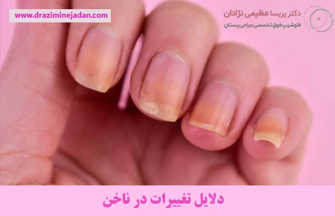 دلایل تغییرات در ناخن