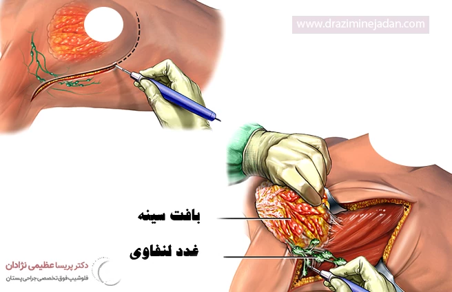 دلیل انجام ماستکتومی