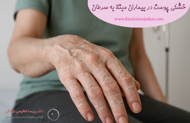 خشکی پوست در بیماران مبتلا به سرطان